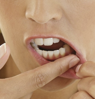 How to avoid and treat mouth ulcers?