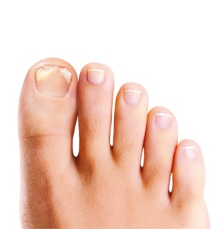 Traitement ongles abîmés : traiter infections fongiques des pieds &  traumatismes - URGO URGO