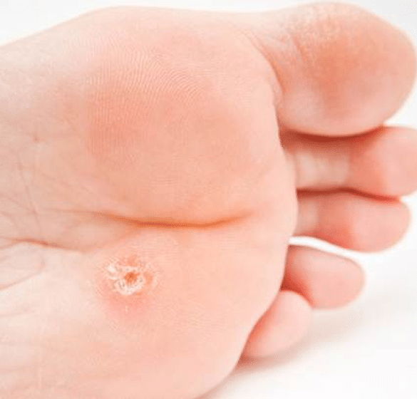 How to treat and prevent warts?